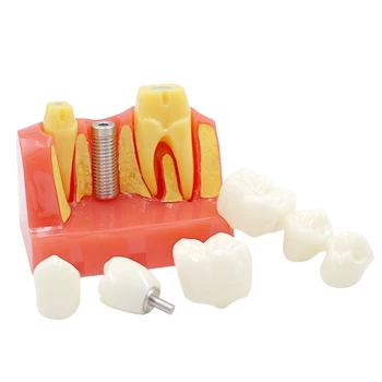 Зубной Имплантат Четырехкратная Обучающая Модель Зубов Четырехкратная Модель Обучения Стоматолога Патологическая Модель